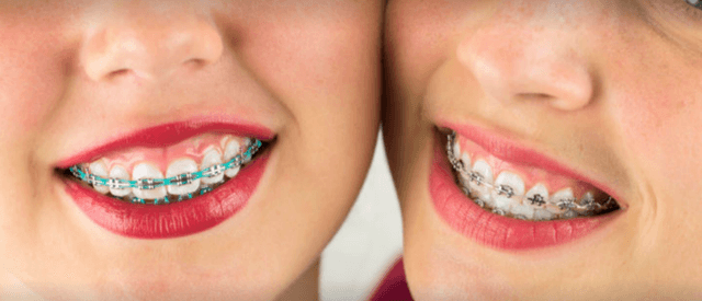 On the Go Braces photo