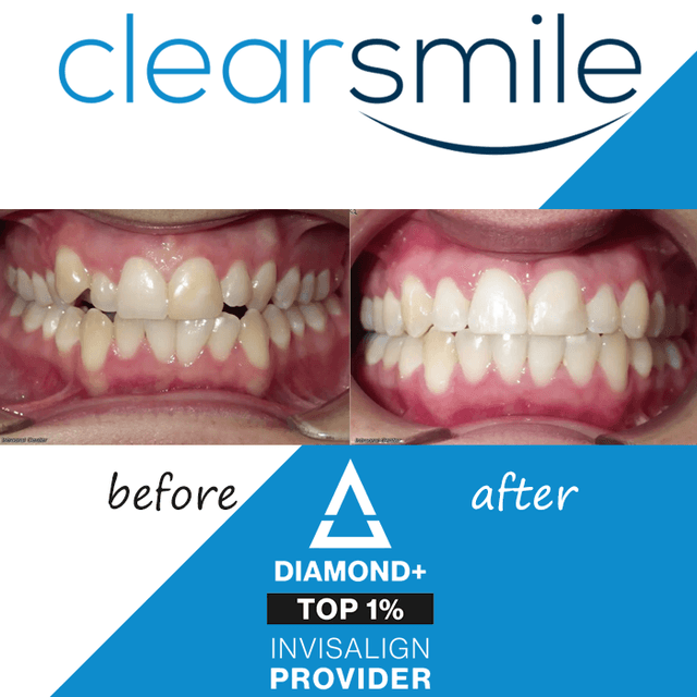 Clearsmile - Invisalign photo