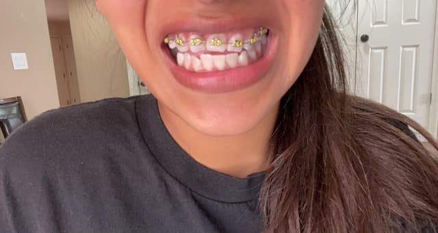 $99 Braces photo
