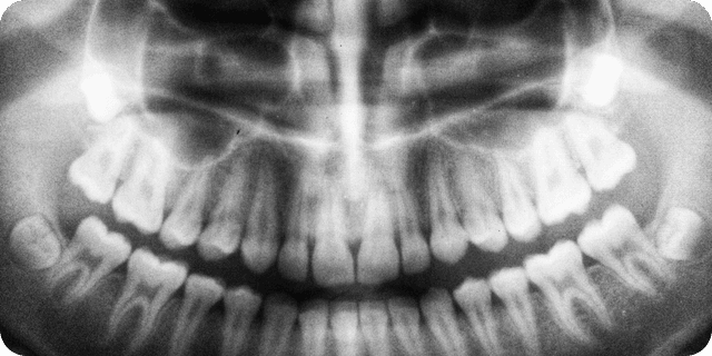 An X-ray result of a person's teeth